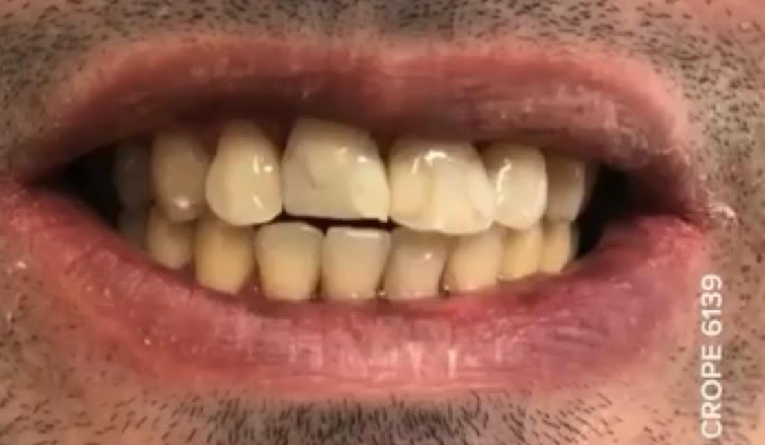 Estética Dental — antes
