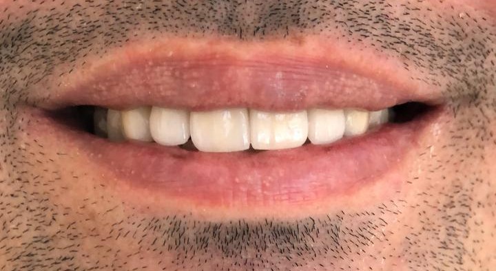 Estética Dental — depois