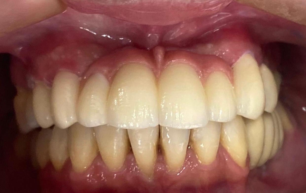 Implante Dentário — depois
